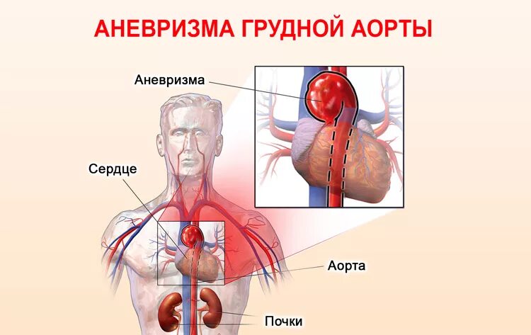 Аневризма аорты сердца что это симптомы лечение. Аневризмы синусов вальсальвы. расширение восходящего отдела аорты сердца. аневризма восходящего отдела сердца. аневризма грудного отдела аорты симптомы разрыв.