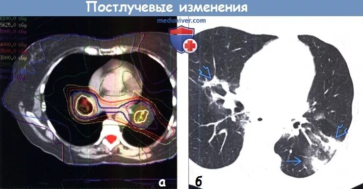 Постлучевой пневмофиброз кт. Постлучевой пульмонит кт. Постлучевые изменения в легких на кт.