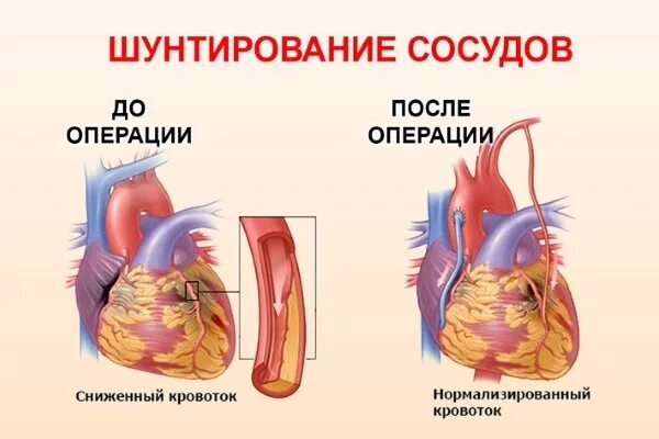 Шунтирование при инфаркте миокарда операция. Шунты при коронарном шунтировании. Что такое шунтирование сердца при инфаркте миокарда. Коронарное шунтирование сосудов сердца.