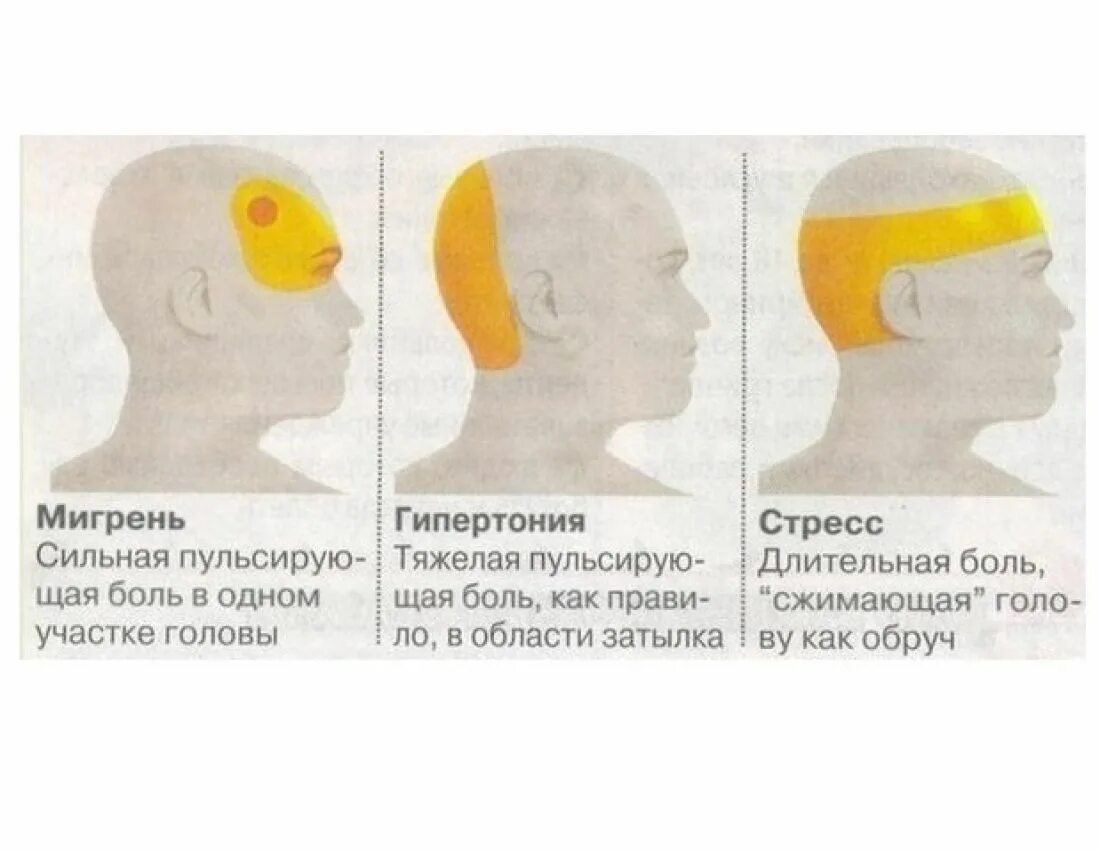 Сильные боли в затылочной части. Головная боль. Зоны головной боли. Боль в голове. Головная боль локализация.