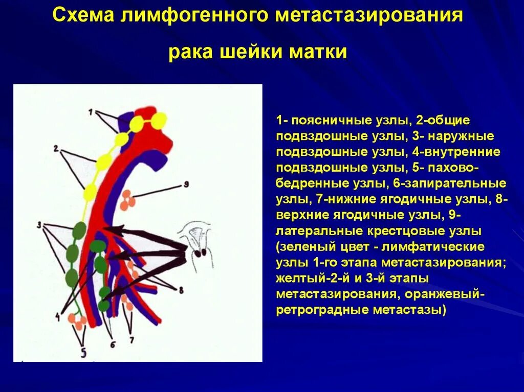 Отдаленные метастазы РШМ. Регионарные лимфатические узлы. Регионарные лимфатические узлы матки. Регионарные лимфатические узлы шейки матки. Боли при раке шейки