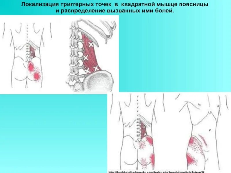 Триггера в квадратной мышце поясницы. Подвздошно-поясничная мышца триггерные точки. Миофасциальный синдром квадратной мышцы поясницы. Подвздошно-поясничная мышца триггерные боли. Боль в пояснице триггерные точки.