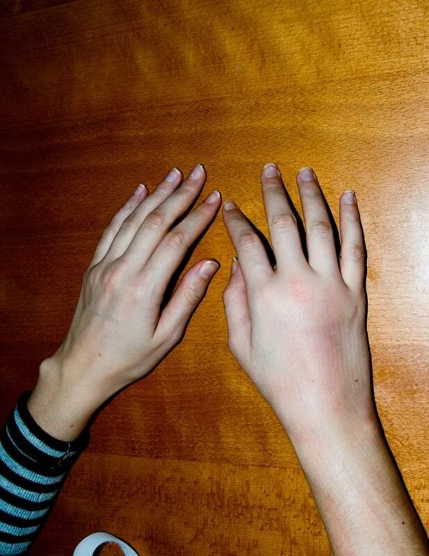 Руки. Очень сильно болит рука. Опухшая рука от перелома.