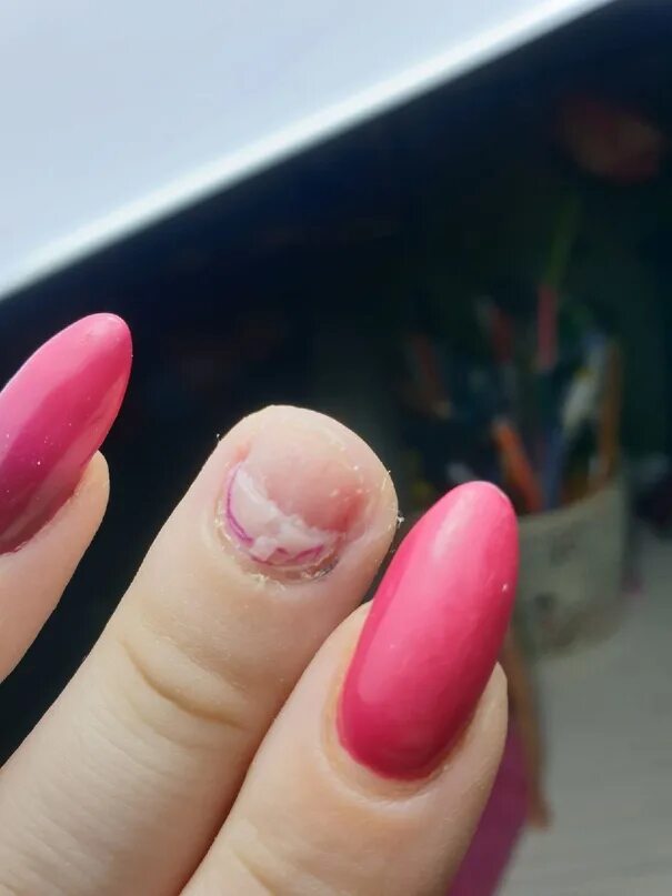 Ногти пульсируют. Панариций околр нргтевой. Ногти до и после маникюра. Ногти пульсируют. Понацири.