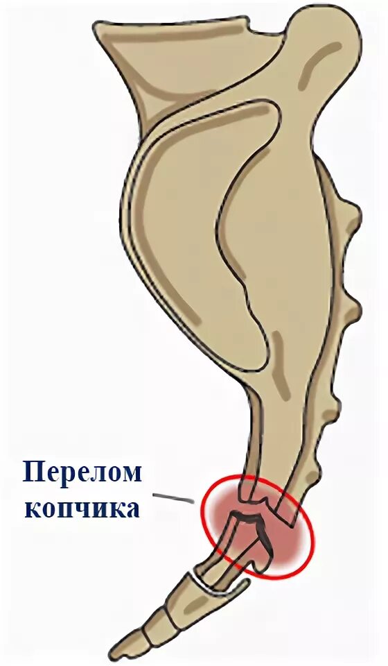 Трещина после падения. Импрессионный перелом копчика. Перелом отростка копчика. Перелом 1 копчикового позвонка. Осколочный перелом копчика.