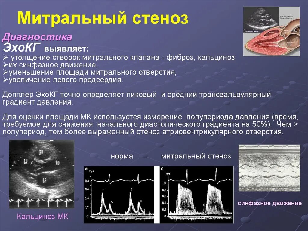 Эхо-кг при стенозе митрального клапана. Эхокардиография стеноз митрального клапана. Аортальный стеноз допплер ЭХОКГ.