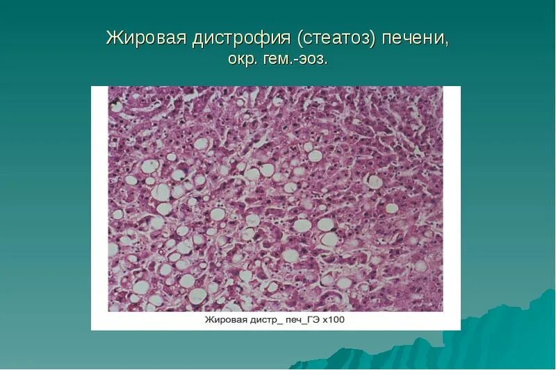 Острая жировая печень. Жировой гепатоз печени гистология. Хронический вирусный гепатит макропрепарат. Жировая дистрофия печени макропрепарат. Жировая дистрофия стеатоз печени микропрепарат патанатомия.