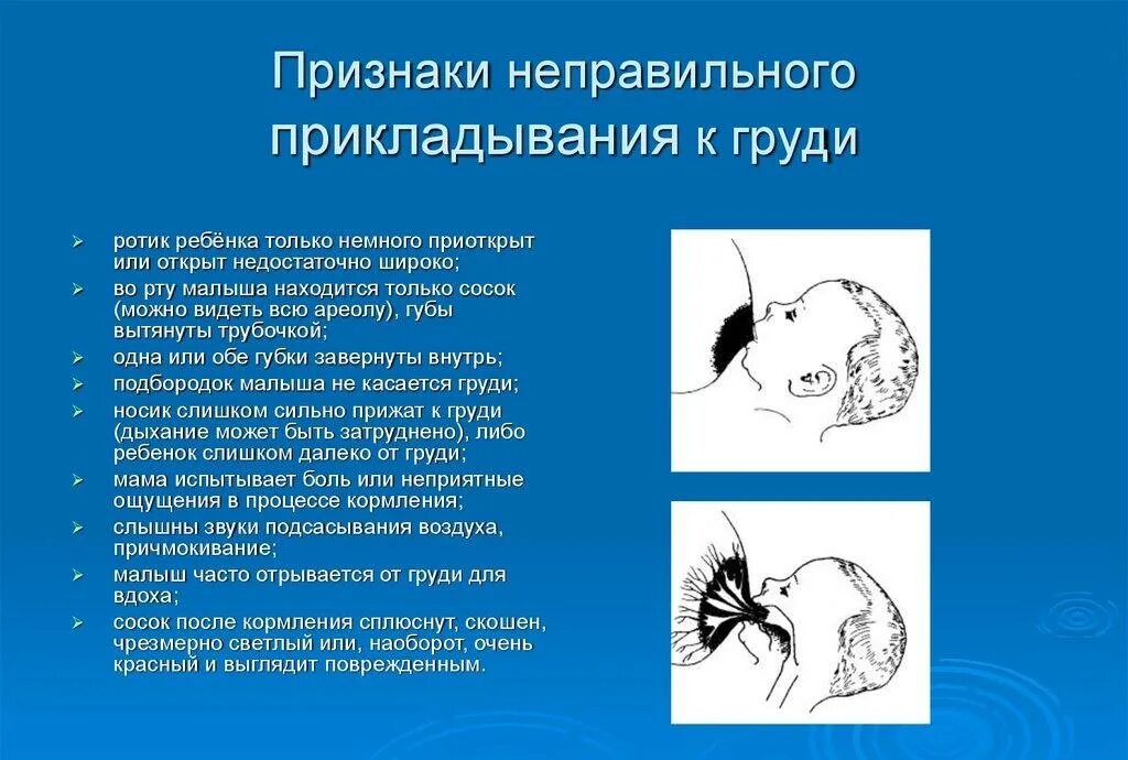 Неправильный захват. Правильное прикладывание к груди. Технике прикладывания ребенка к груди. Признаки неправильного прикладывания ребенка. Неправильное прикладывание ребенка к груди.