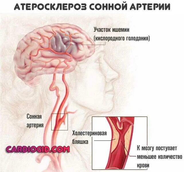 Атеросклеротическое поражение сосудов головного мозга. Ишемический инсульт сонной артерии. Атеросклероз сосудов сонных артерий. Атеросклероз сонных артерий осложнения. Симптомы проблем с сосудами головного