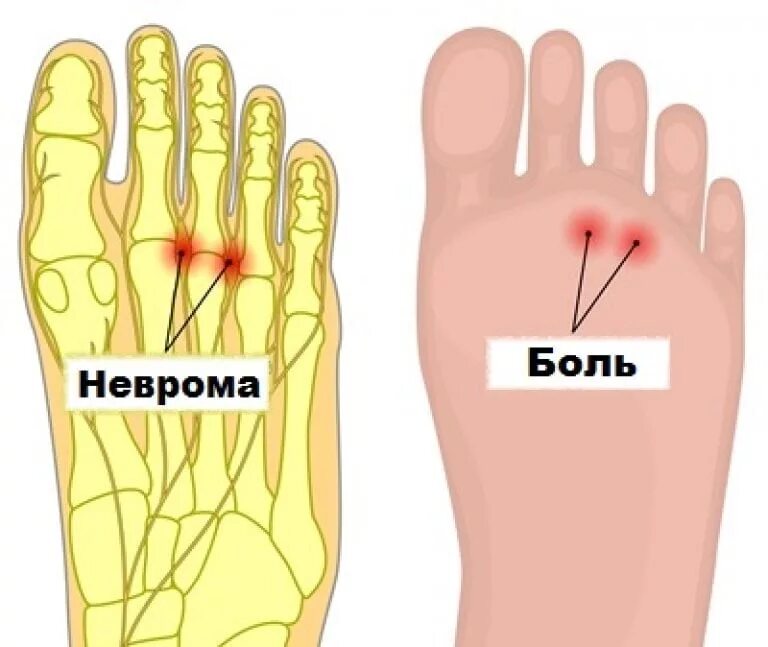 Почему болит подушечка ноги. Неврома Мортона симптомы. Неврома Мортона на пальцах ног.