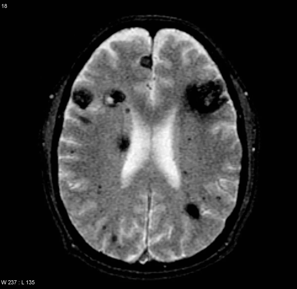 Лейкоэнцефалит