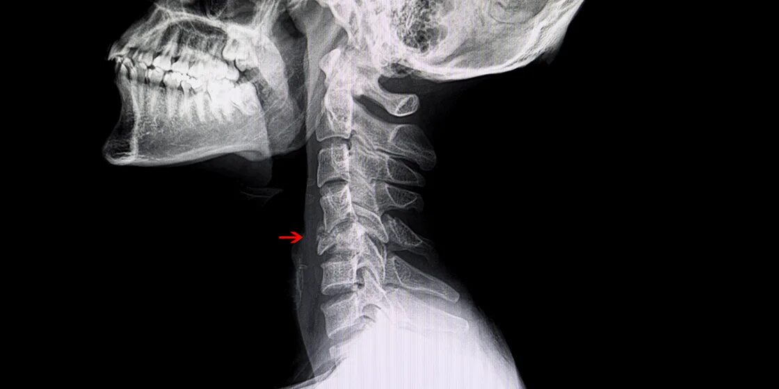 Трещина пациент. Перелом шейных позвонков. Перелом позвоночника рентген.