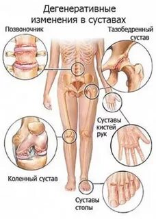Онкология суставов