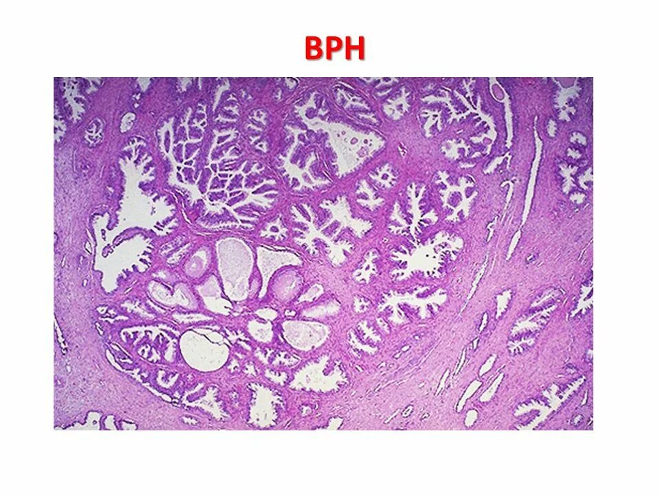 Железистая гиперплазия предстательной железы. Предстательная железа гистология. Гиперплазия предстательной железы микропрепарат. Железистая гипертрофия предстательной железы микропрепарат.
