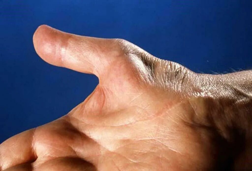 Атрофия большого пальца руки. Нападение большого пальца