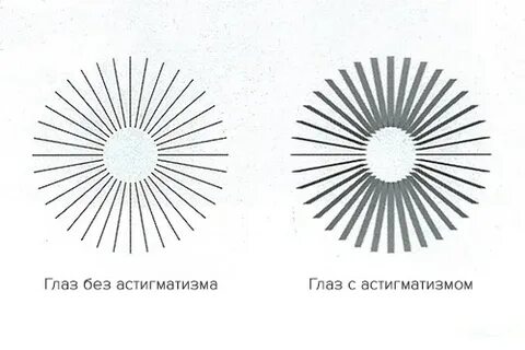 Астигматизм глаз форум