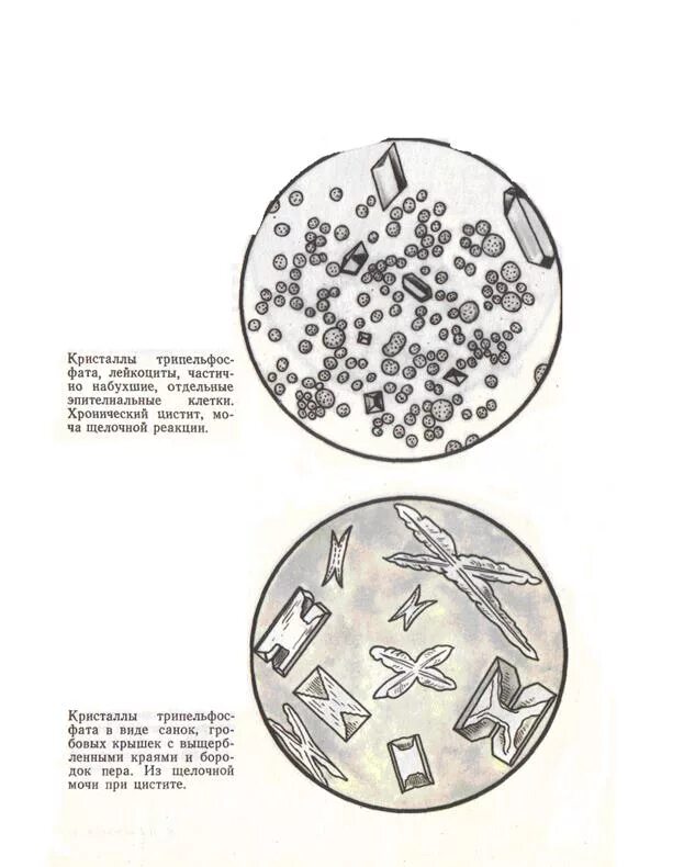 Фосфаты в какой моче. Ксантин в моче микроскопия. Кристаллы в моче микроскопия. Цистин в моче микроскопия. Кристаллы лейцина в моче.