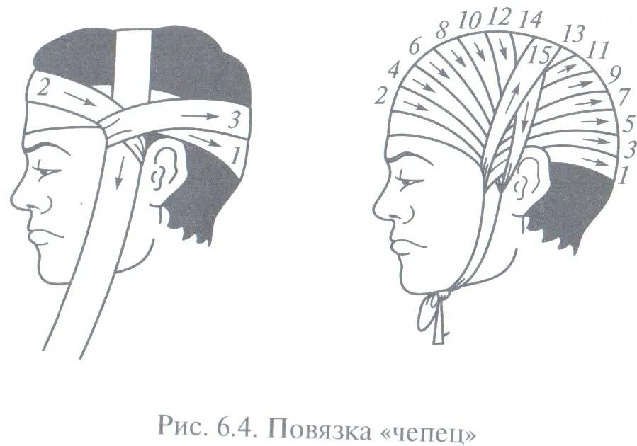 Как перевязывать голову. Техника наложения повязки чепец. Бинтование чепец. Бинтовая повязка чепец. Перевязка головы чепец.