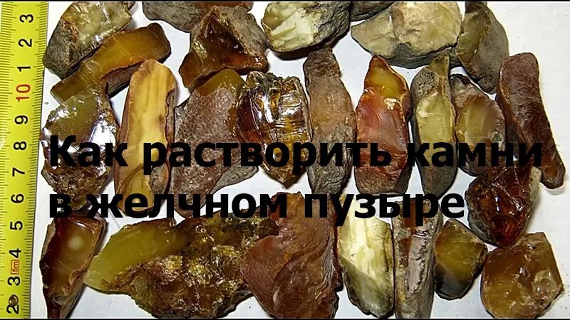 Растворить желчных камнях без операции. Препараты для растворения желчных камней. Растворить желчных камнях без операции. Желчнокаменная болезнь (жкб). Растворить желчных камнях без операции.