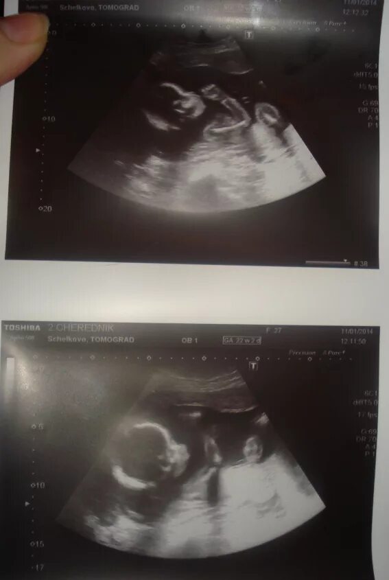 живот на 16 неделе беременности. 16 неделя 23 года. 16 неделя 23 года. узи на 16-17 неделе беременности пол. живот на 16 неделе беременности двойней.