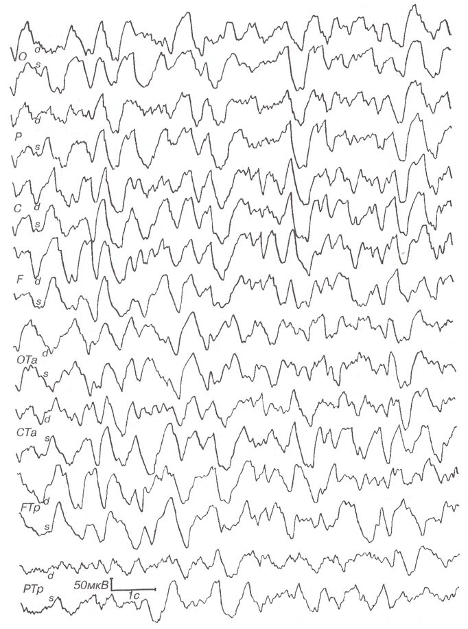 Пароксизмальная ээг. Электроэнцефалография головного мозга (ЭЭГ). РЭГ И ЭЭГ. ЭЭГ РЭГ головного мозга. ЭЭГ кардиограмма.