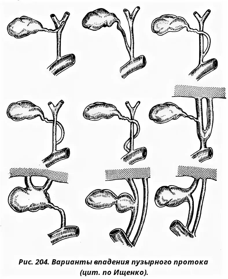 Варианты желчного пузыря. Аномалии развития желчных протоков. Варианты впадения пузырного протока. Культя общего желчного протока. Синдром длинной культи пузырного протока.