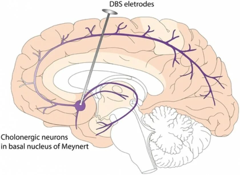 Стимуляция мозга ребенка. Basal Nucleus of Meynert. Глубокая стимуляция мозга. Спайка Мейнерта. DBS стимуляция головного.