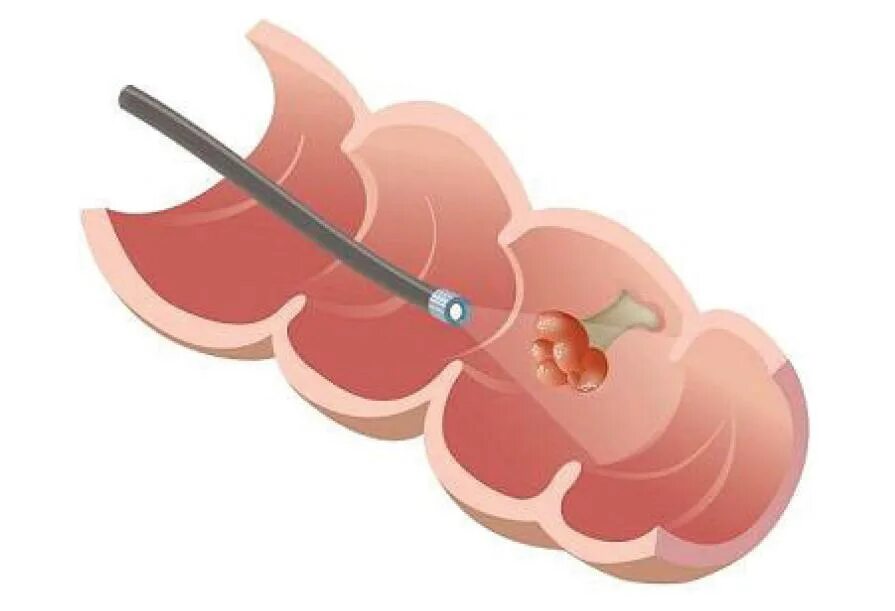 Биопсией слизистой оболочки. Эндоскопическая петлевая электроэксцизия полипов. Эндоскопическая полипэктомия толстой кишки. Полип прямой кишки эндоскопия.