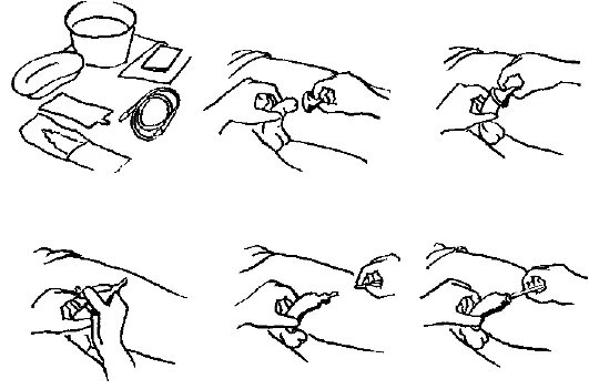 Мужчина открывает головку. Внешний мочевой катетер алгоритм. Уход за постоянным мочевым катетером. Внешний мочевой катетер мужчине алгоритм. Уход на внешнис мочевым катктером.