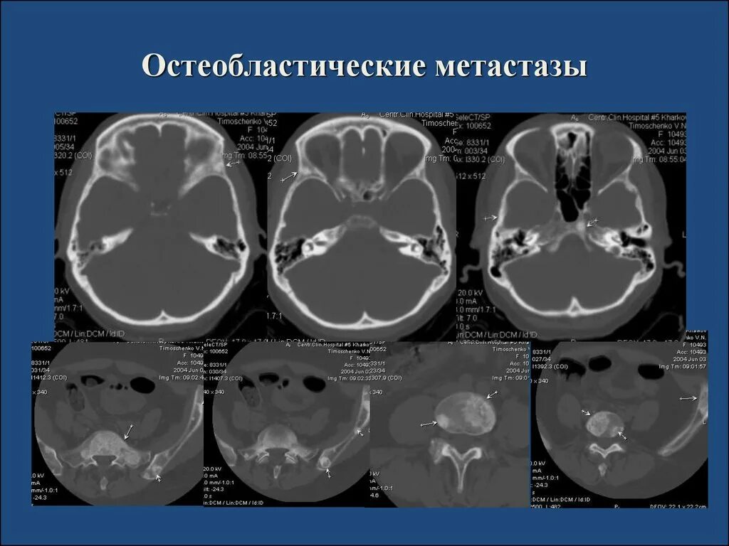 Очаговые изменения костей. Остеобластический метастаз на кт. Метастазы в кости черепа на кт.