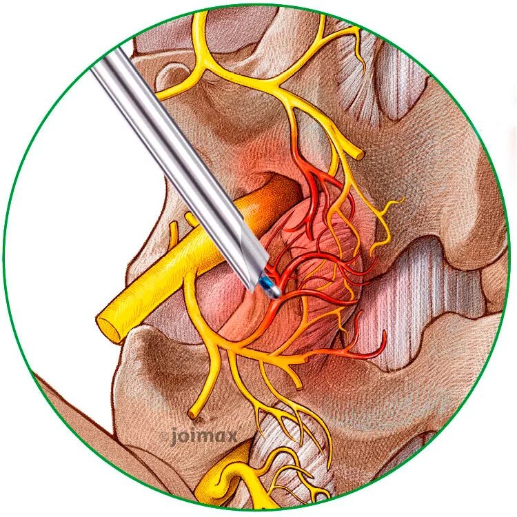Грыжа мозговых оболочек освобождение нерва. Блокада фасеточного сустава l5-s1. Фасеточный синдром l5-s1. Фасеточные суставы поясничного отдела позвоночника. Радиочастотная деструкция фасеточных суставов.