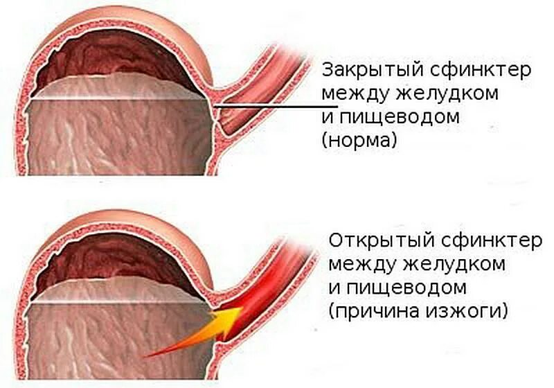 Между пищеводом. Сфинктер между желудком и пищеводом. Изжога причины. Причины появления изжоги.