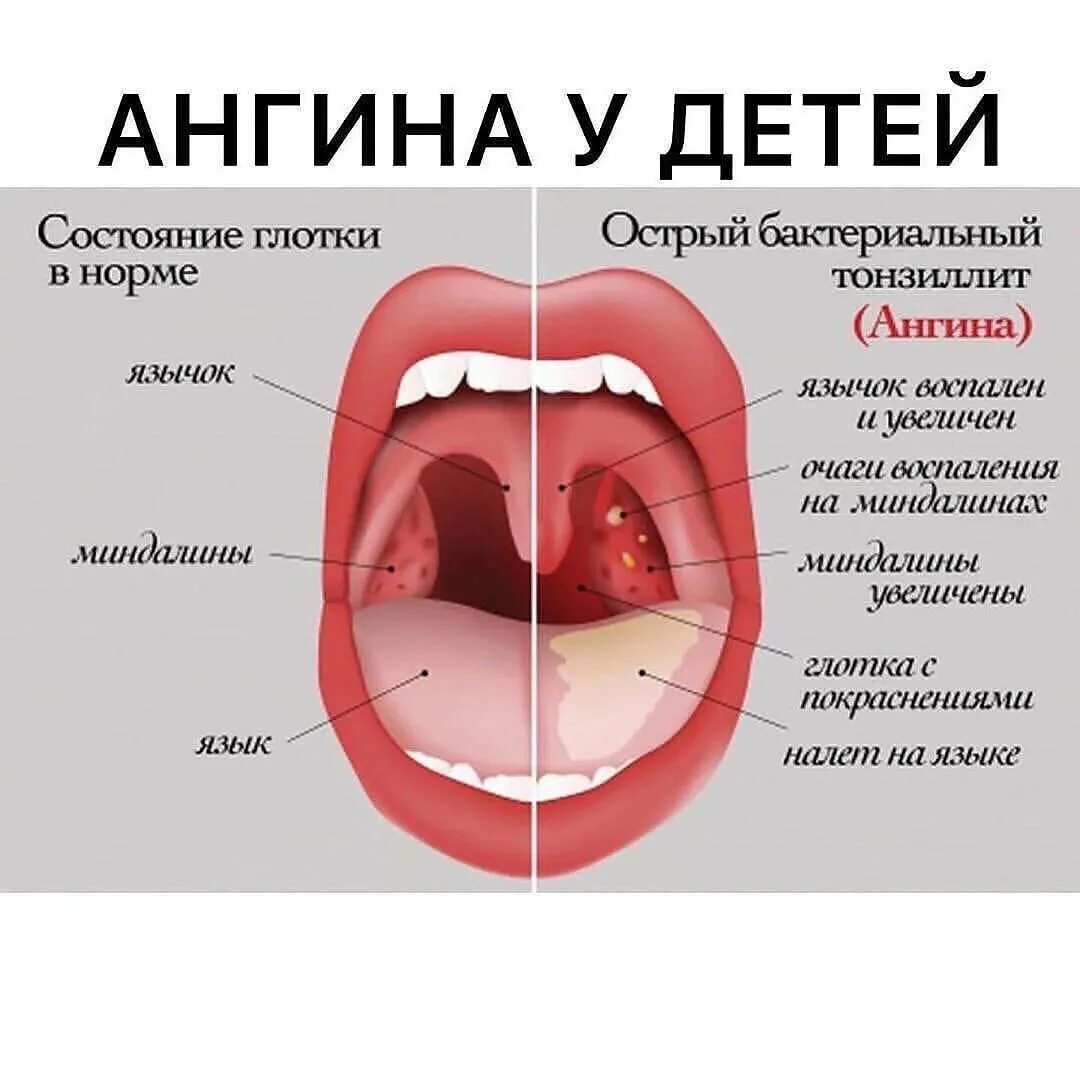 Ангина лечение быстро детям. Ангина лечение быстро детям