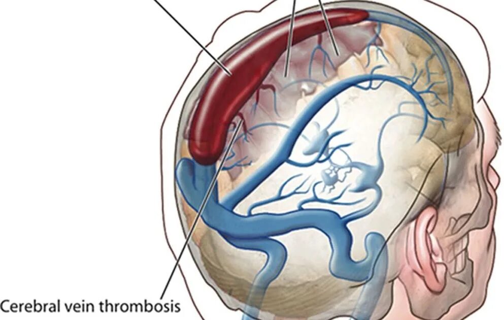 Церебрального тромбоза. Тромбоз пещеристого синуса твердой мозговой оболочки. Тромбоз пещеристого синуса кт. Тромбоз синус кавернозус. Тромбоз пещеристого синуса клиника.