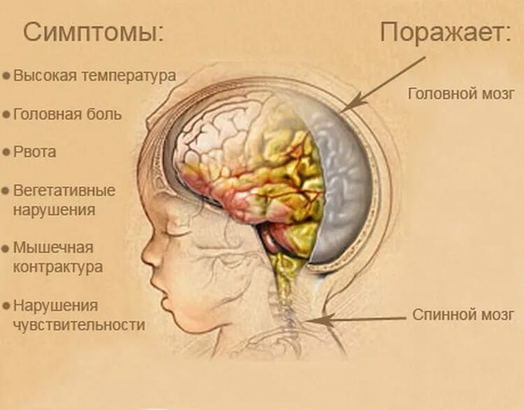 Пульсирует родничок. Воспаление головного мозга симптомы менингит. Воспаление оболочек головного мозга. Серозный туберкулёзный менингит. Оболочка головного мозга менингит.