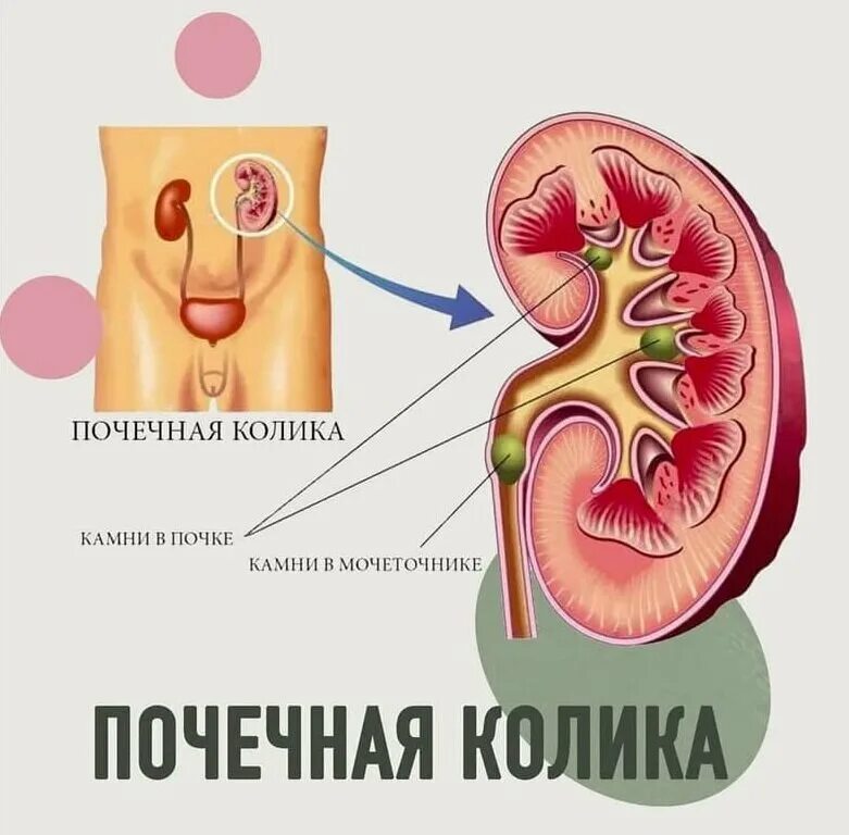 Мочекаменная болезнь колики. Почечная колика. Мочекаменная болезнь почечная колика. Колики в почках симптомы.