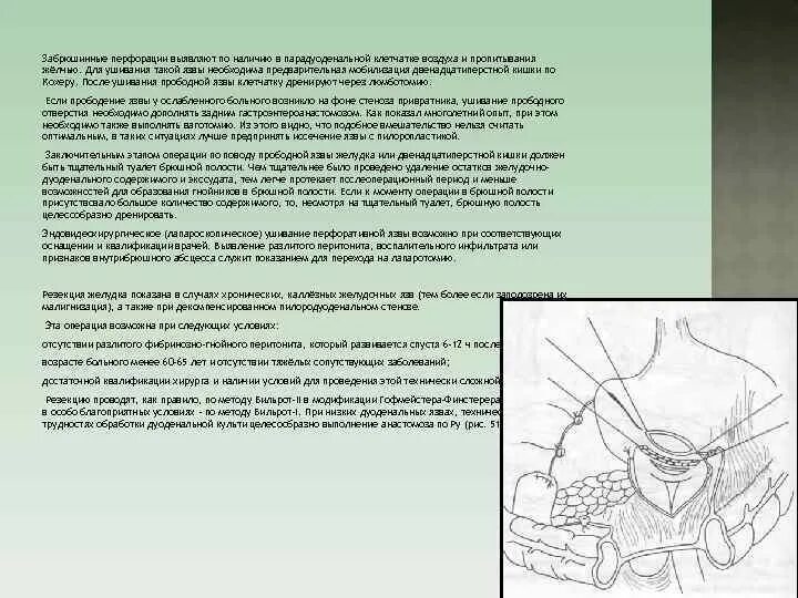 Язва операция сколько. Ушивание прободной язвы ДПК. Мобилизация желудка по Кохеру. Маневр кохера мобилизация двенадцатиперстной кишки. Язва 12 перстной перитонит.