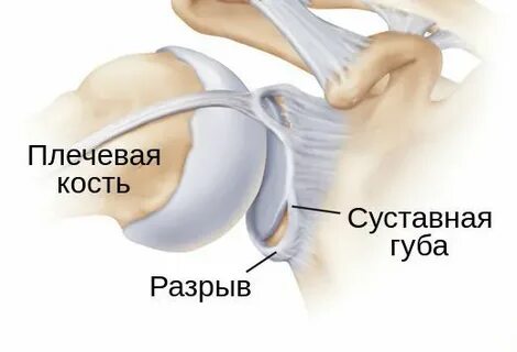 Губа в плече