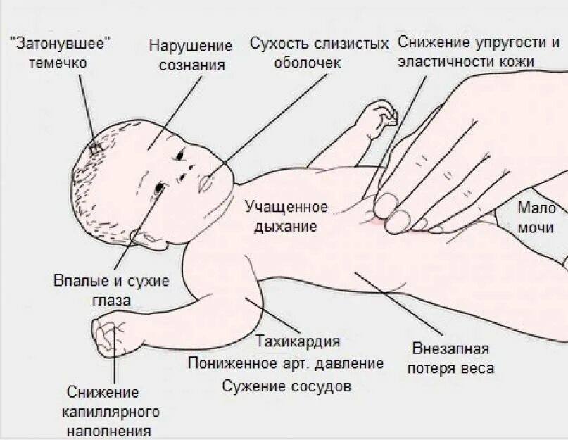 Признаки обезвоживания у ребенка 1 год. Симптомы обезвоживания у ребенка при ротовирусе. Обезвоживание организма у ребенка симптомы 1 год. Как проявляется обезвоживание у грудничка.