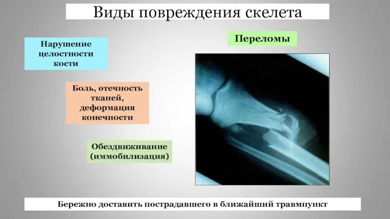 Типы повреждения скелета. Перелом вывих растяжение. Травмы опорно двигательной системы.