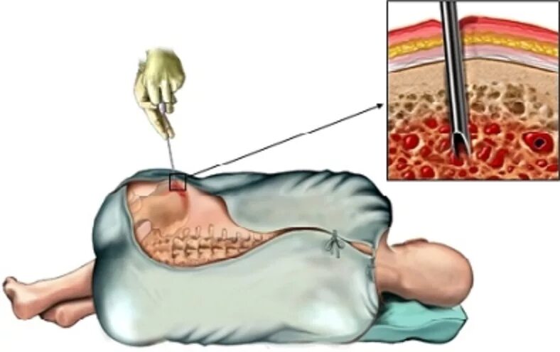 Трепанобиопсия костного мозга. Трепан биопсия подвздошной кости. Трепанобиопсия пунктат костного мозга. Трепанобиопсия при лейкозе. Стерильная пункция