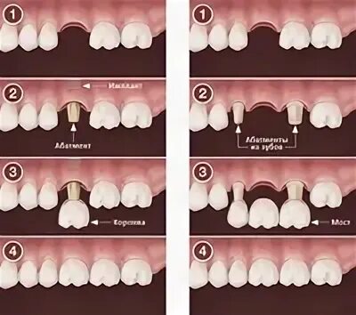 Зубы импланты поэтапно. Одномоментная имплантация передних зубов. Этапы имплантации зубов. Формы зубных имплантатов. Имплантат переднего зуба.