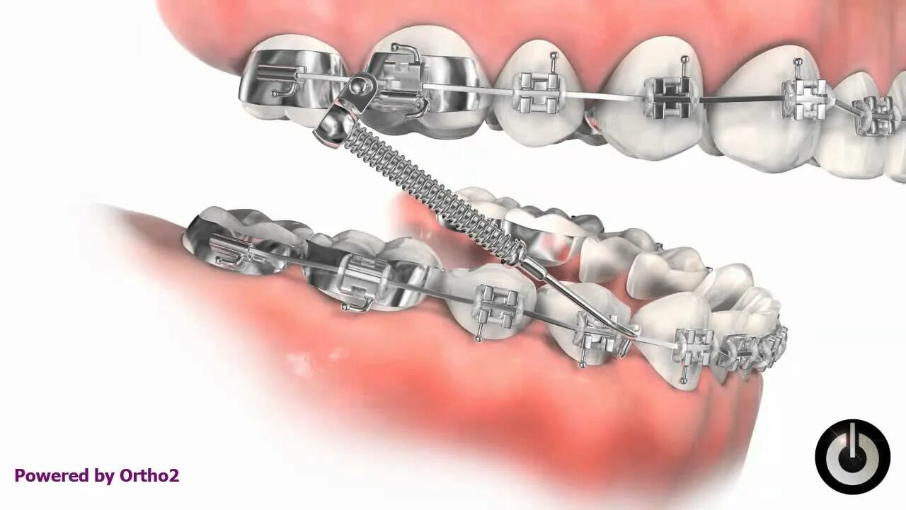 Брекеты с пружиной. Аппарат forsus для выдвижения нижней челюсти. Аппарат jasper jumper ортодонтический. Брекеты с пружиной. Форсус аппарат для дистального прикуса.