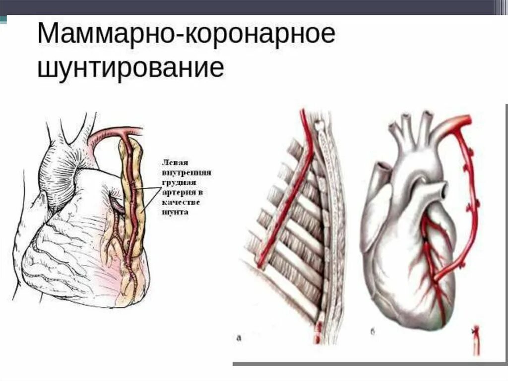 Можно ли после акш. Маммарокоронарное шунтирование (акш и мкш). операция мкш-пмжв акш втк. операция колесова маммарно коронарное шунтирование. аортокоронарное шунтирование при ибс.