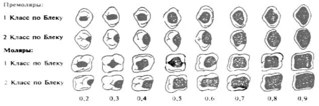 Иропз. Классификация полостей по иропз. Индекс разрушения окклюзионной поверхности зуба иропз. Иропз в стоматологии. Индекс разрушения окклюзионной поверхности зуба иропз.