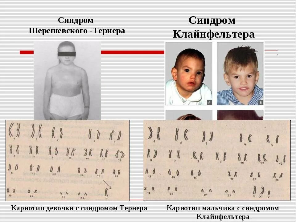 Синдром тернера мкб 10. Синдром шерешевского тернера кариотип. синдром шерешевского тернера фенотип. синдром шерешевского тернера диагностика. синдром шерешевского тернера синдром клайнфельтера.
