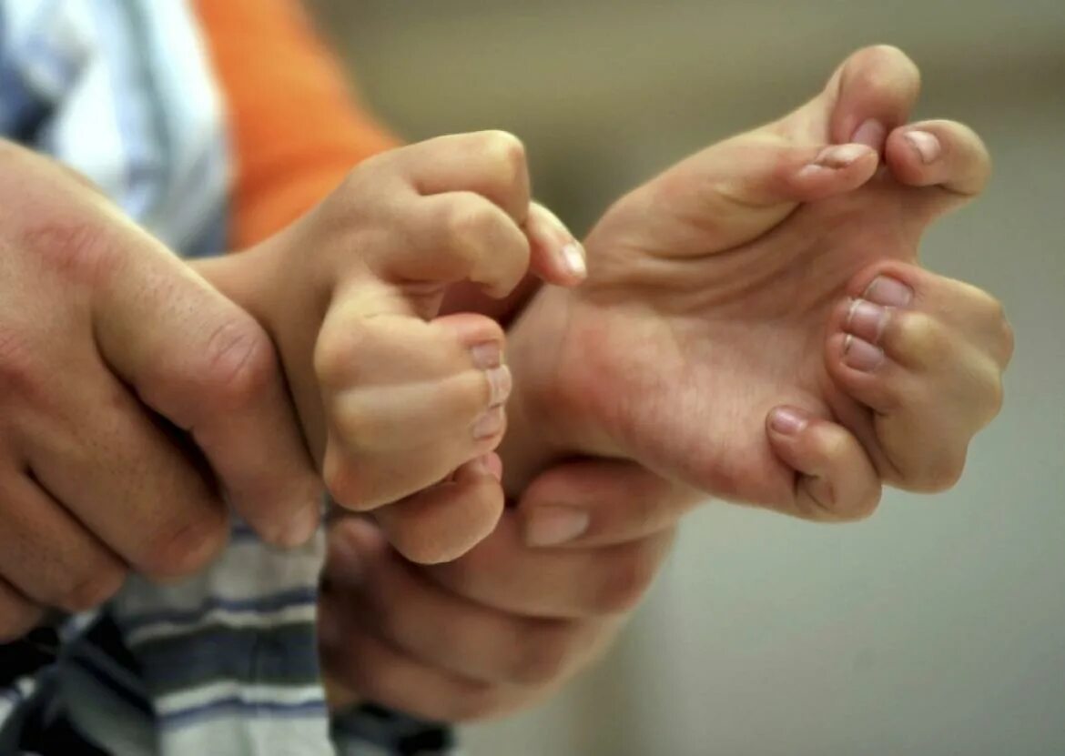 Дети с шестью пальцами. Новорожденный с 6 пальчиком. Синдром патау полидактилия. Йоандри эрнандес гарридо. Дети родившиеся с шестым пальцем на руке.