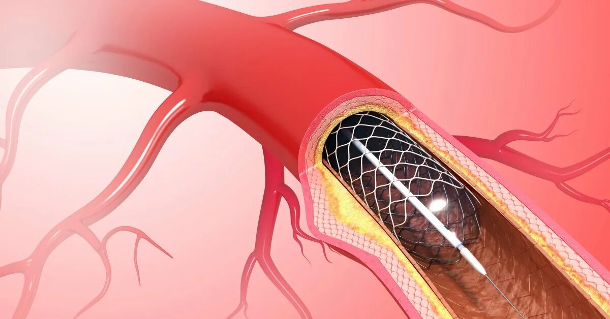 Эндоваскулярное стентирование коронарных артерий. Xience Alpine стент. Коронарная ангиопластика и стентирование. Операция стентирование сосудов сердца. Расширение сердечного сосуда