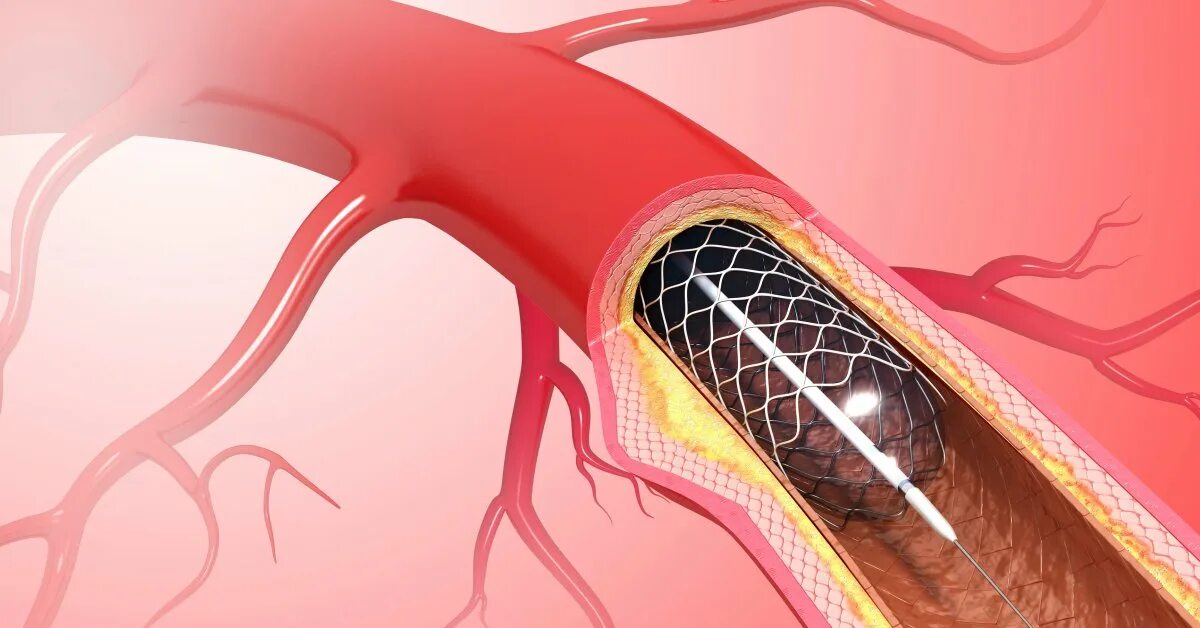 Стентирование рекомендации. Эндоваскулярное стентирование коронарных артерий. Xience Alpine стент. Коронарная ангиопластика и стентирование. Операция стентирование сосудов сердца.