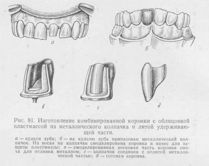 Изготовление металлоакриловых коронок этапы. Белкин комбинированные коронки. Коронка по Белкину препарирование. Комбинированный метод штамповки коронок.